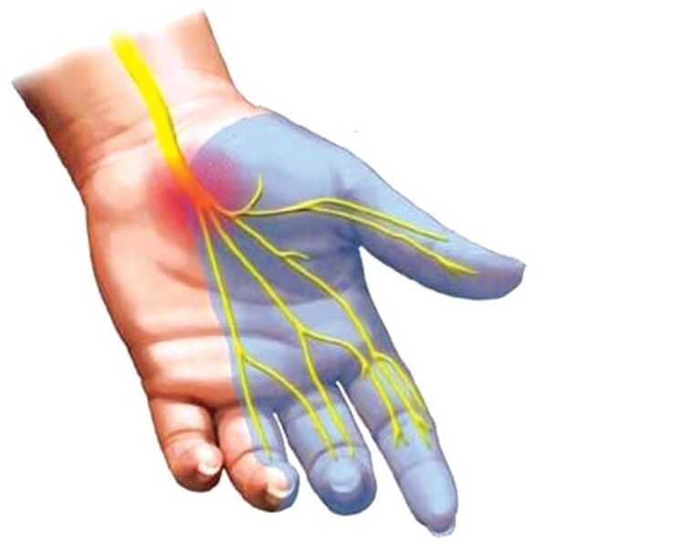 engourdissement de la main avec ostéochondrose