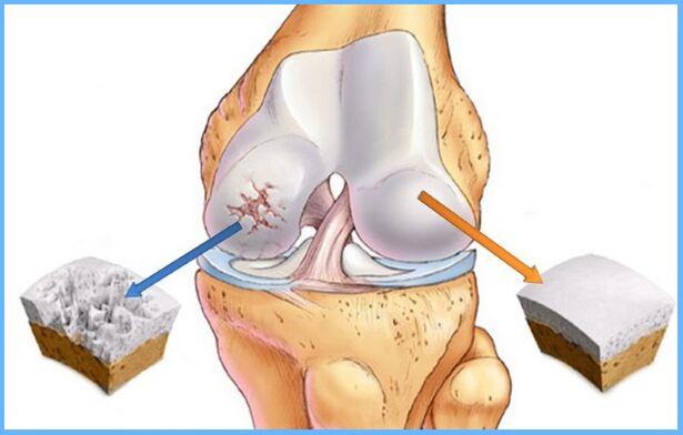 Arthrose de l'articulation du genou