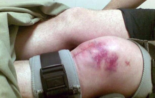 Les causes de l'arthrose de l'articulation du genou