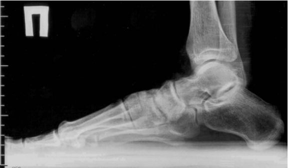 Arthrose des doigts et des pieds
